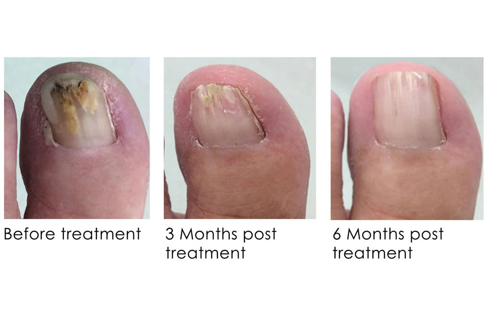 ANTI-FUNGAL NAIL REPAIR POLISH
